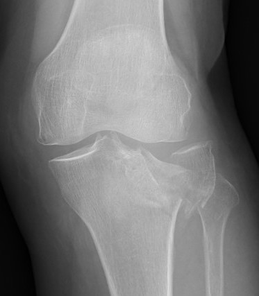 Posterolateral Tibial Plateau